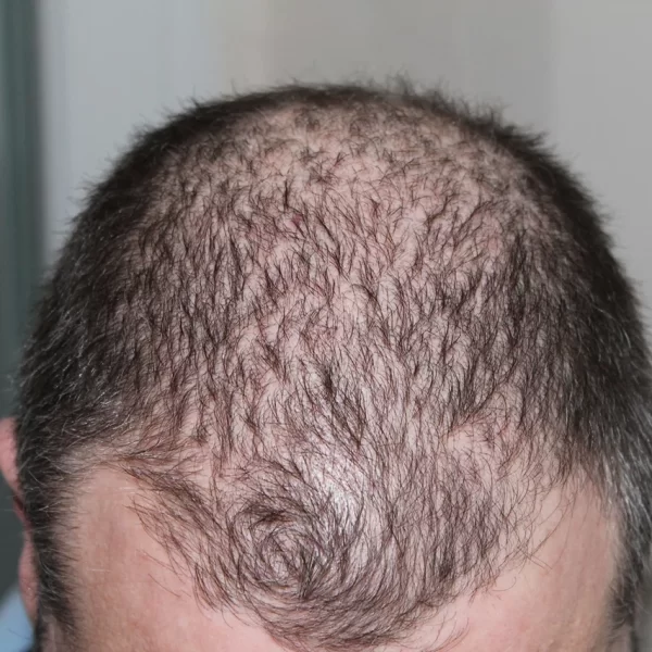 Hair Loss